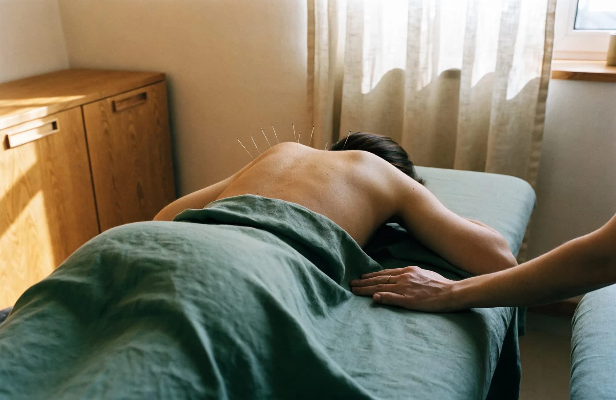 Fine acupuncture needles along a patient's upper back during a treatment